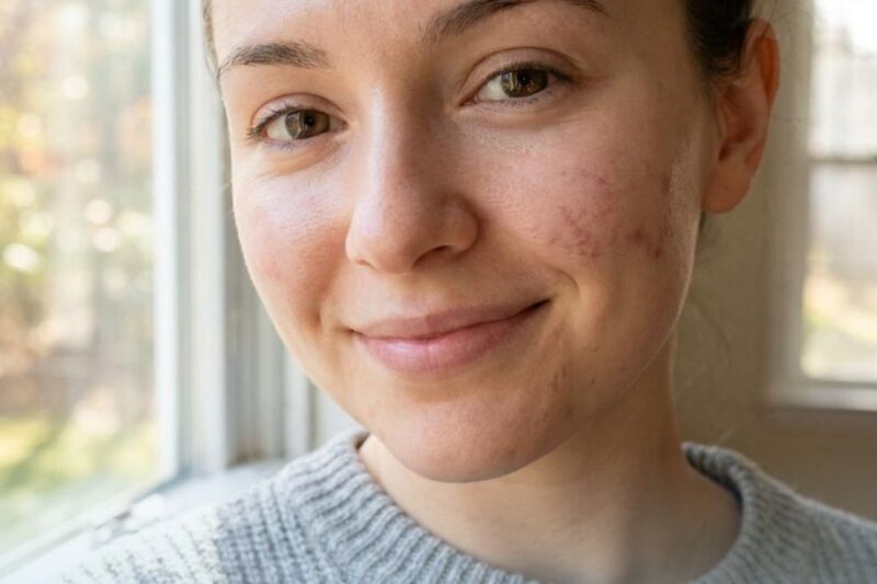 Woman smiling with clear skin indoors.