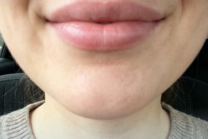 Close-up of lips with enhancement treatment.